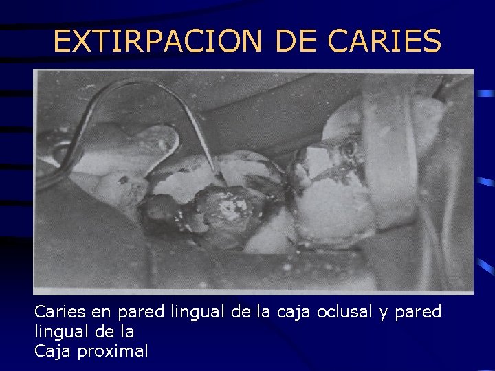 EXTIRPACION DE CARIES Caries en pared lingual de la caja oclusal y pared lingual
