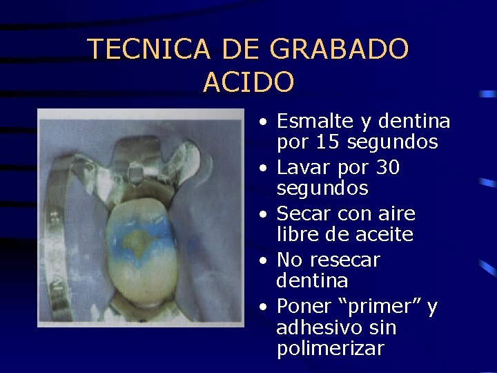 TECNICA DE GRABADO ACIDO • Esmalte y dentina por 15 segundos • Lavar por