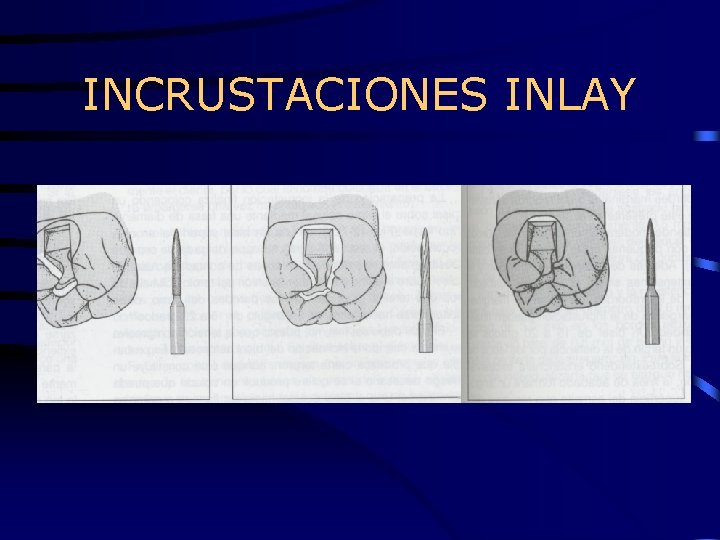 INCRUSTACIONES INLAY 