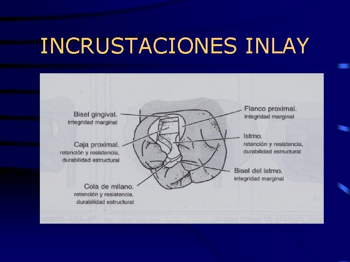 INCRUSTACIONES INLAY 