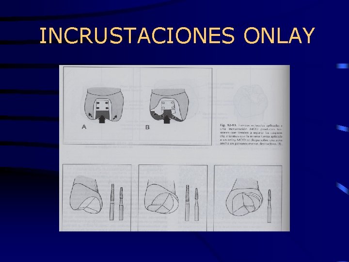 INCRUSTACIONES ONLAY 