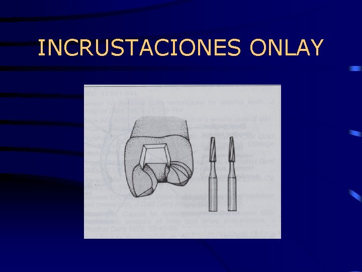 INCRUSTACIONES ONLAY 