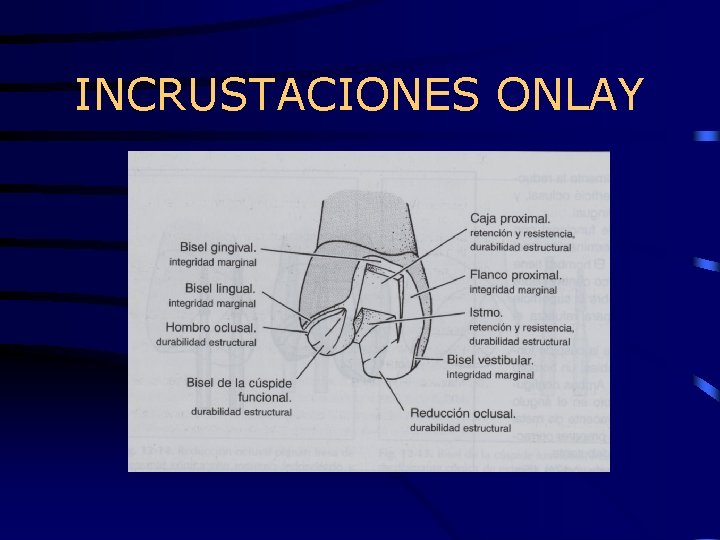 INCRUSTACIONES ONLAY 