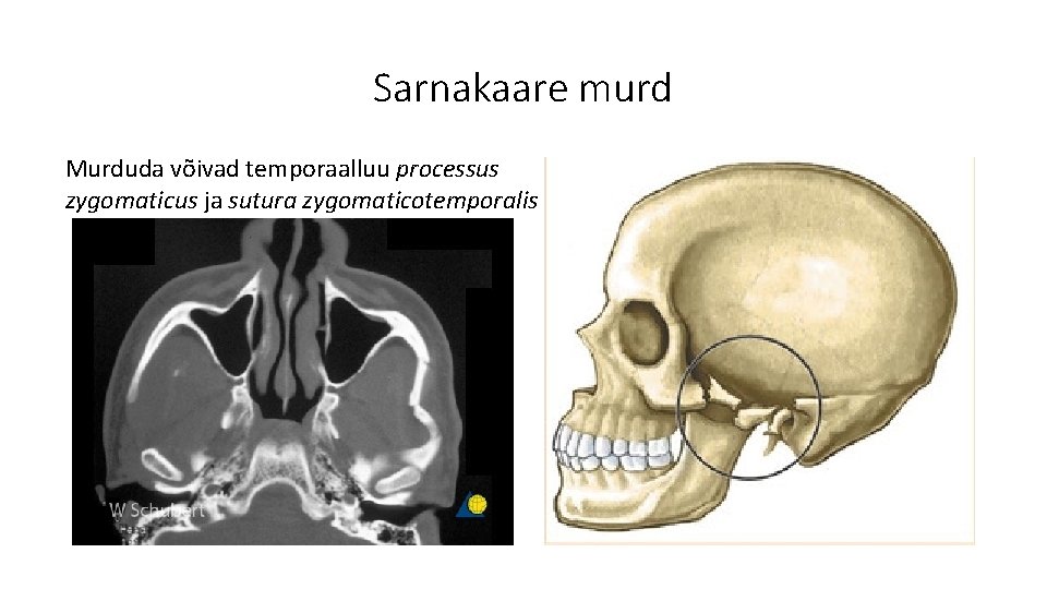 Sarnakaare murd Murduda võivad temporaalluu processus zygomaticus ja sutura zygomaticotemporalis 