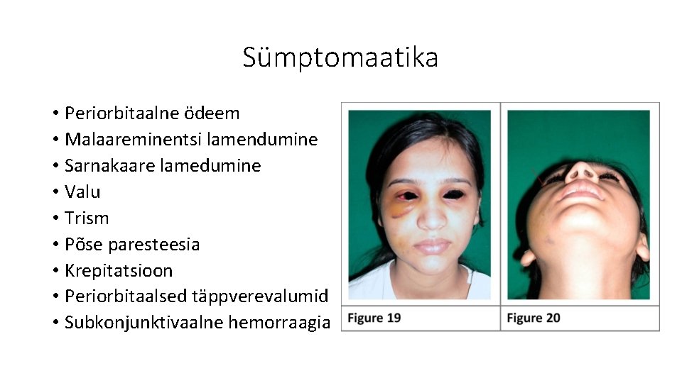 Sümptomaatika • Periorbitaalne ödeem • Malaareminentsi lamendumine • Sarnakaare lamedumine • Valu • Trism