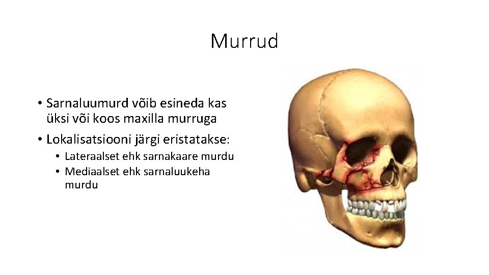 Murrud • Sarnaluumurd võib esineda kas üksi või koos maxilla murruga • Lokalisatsiooni järgi