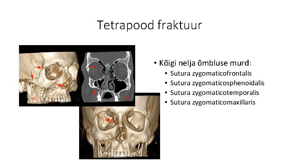 Tetrapood fraktuur • Kõigi nelja õmbluse murd: • • Sutura zygomaticofrontalis Sutura zygomaticosphenoidalis Sutura