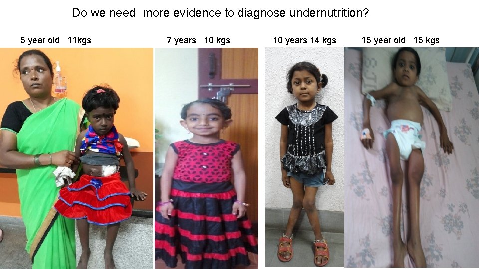 Do we need more evidence to diagnose undernutrition? 5 year old 11 kgs 7 Do we need more evidence to diagnose undernutrition? 5 year old 11 kgs 7