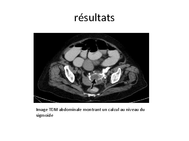 résultats Image TDM abdominale montrant un calcul au niveau du sigmoïde 