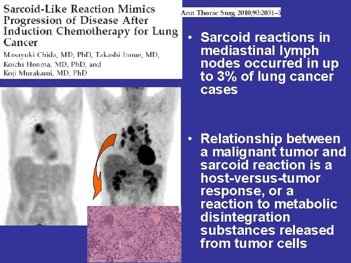  • Sarcoid reactions in mediastinal lymph nodes occurred in up to 3% of