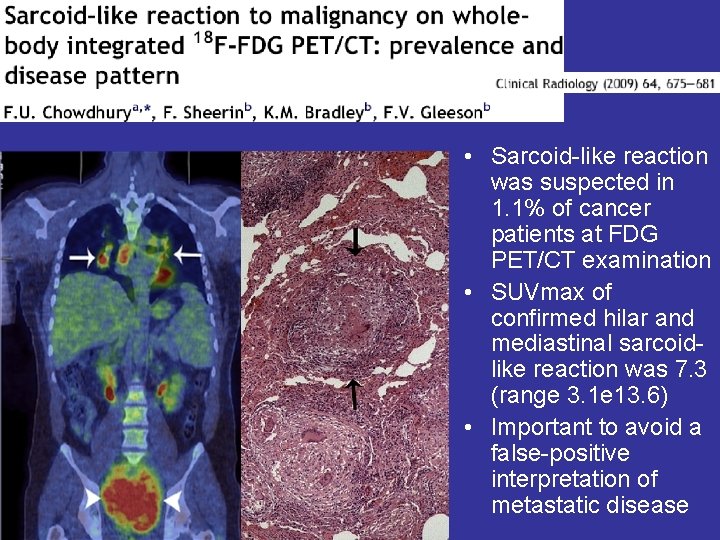  • Sarcoid-like reaction was suspected in 1. 1% of cancer patients at FDG