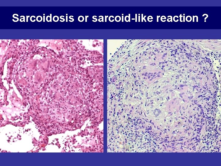 Sarcoidosis or sarcoid-like reaction ? 