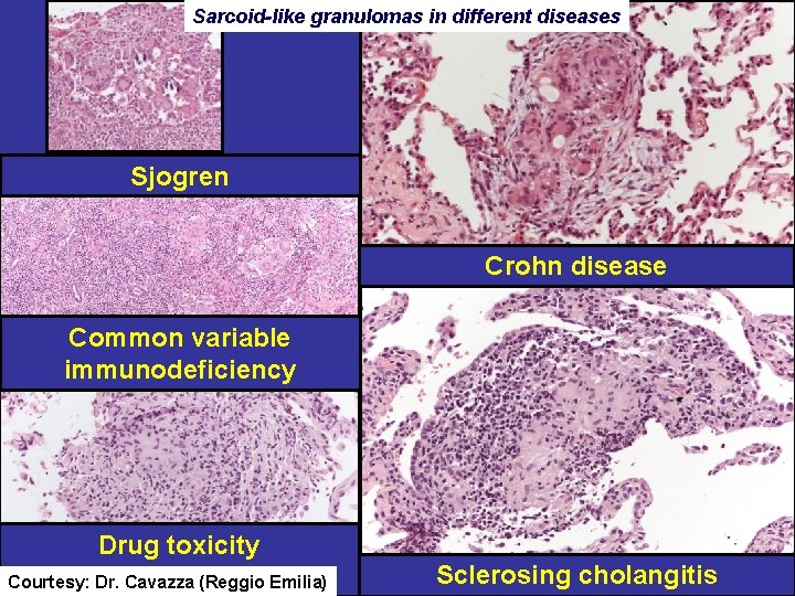 Sarcoid-like granulomas in different diseases Sjogren Crohn disease Common variable immunodeficiency Drug toxicity Courtesy: