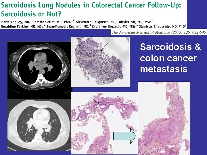Sarcoidosis & colon cancer metastasis 