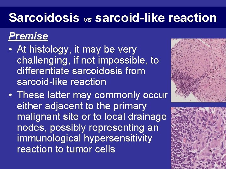 Sarcoidosis vs sarcoid-like reaction Premise • At histology, it may be very challenging, if