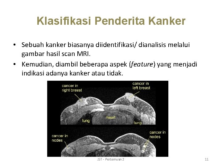 Klasifikasi Penderita Kanker • Sebuah kanker biasanya diidentifikasi/ dianalisis melalui gambar hasil scan MRI.