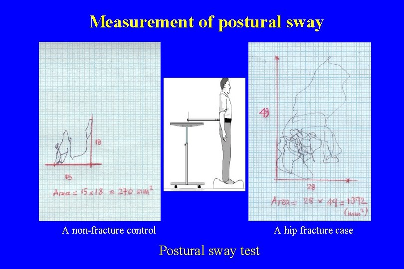 Measurement of postural sway A non-fracture control A hip fracture case Postural sway test