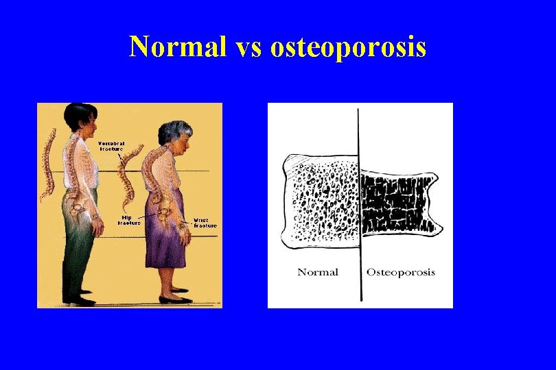 Normal vs osteoporosis 