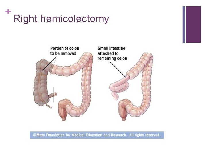 + Right hemicolectomy 