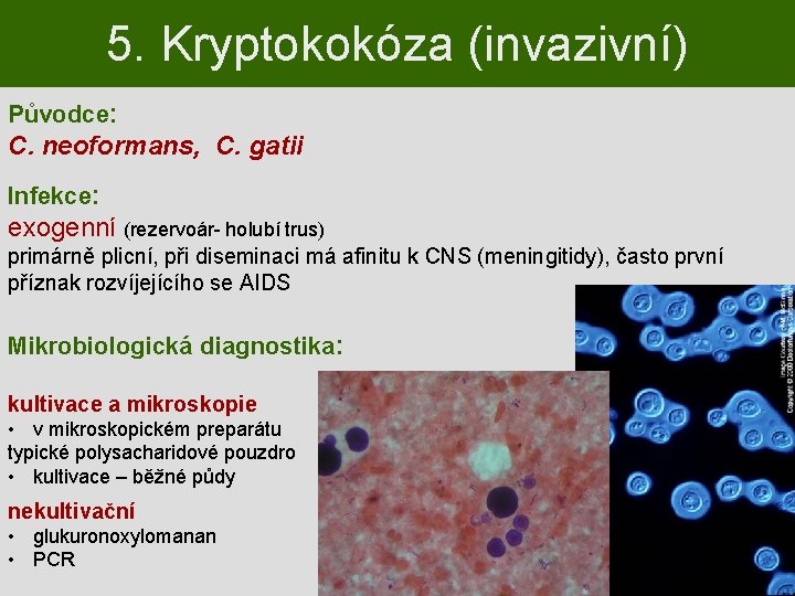 5. Kryptokokóza (invazivní) Původce: C. neoformans, C. gatii Infekce: exogenní (rezervoár- holubí trus) primárně