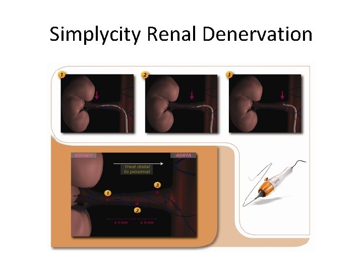 Simplycity Renal Denervation 