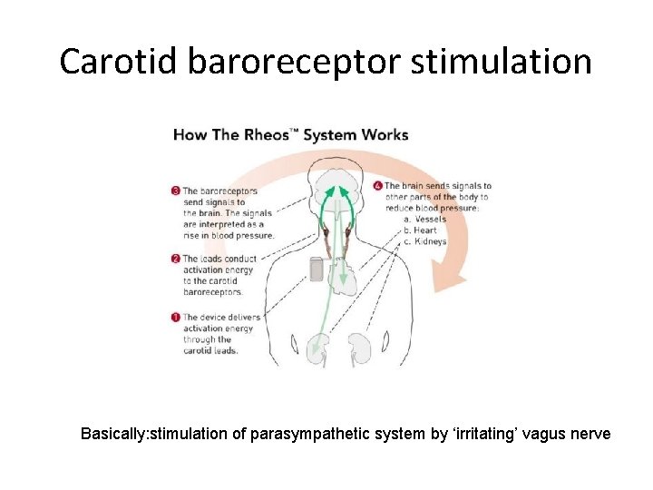 Carotid baroreceptor stimulation Basically: stimulation of parasympathetic system by ‘irritating’ vagus nerve 