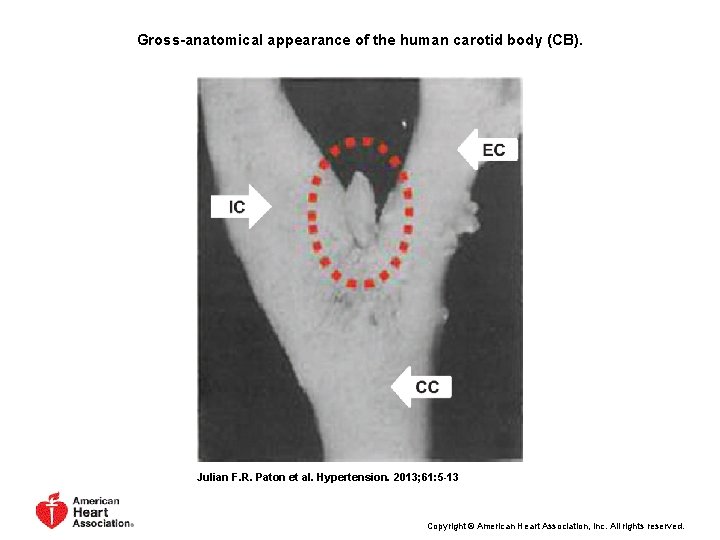 Gross-anatomical appearance of the human carotid body (CB). Julian F. R. Paton et al.