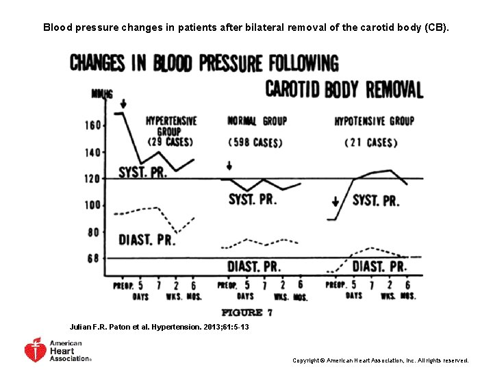 Blood pressure changes in patients after bilateral removal of the carotid body (CB). Julian