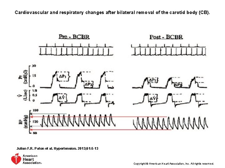 Cardiovascular and respiratory changes after bilateral removal of the carotid body (CB). Julian F.