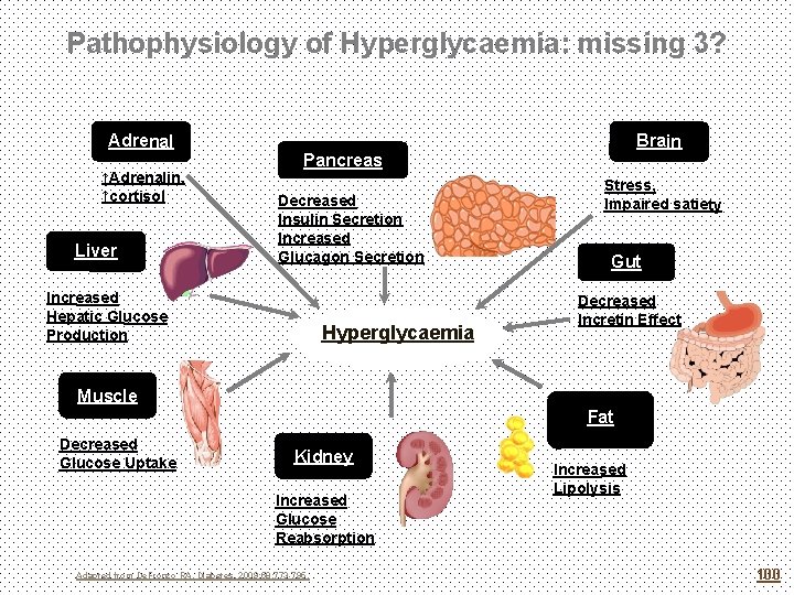 Pathophysiology of Hyperglycaemia: missing 3? Adrenal ↑Adrenalin, ↑cortisol Liver Brain Pancreas Decreased Insulin Secretion