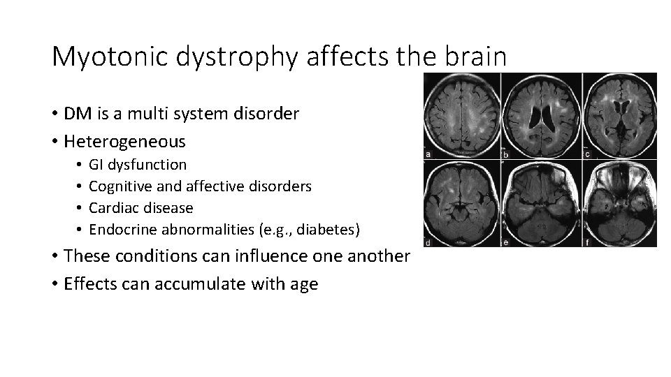 Myotonic dystrophy affects the brain • DM is a multi system disorder • Heterogeneous