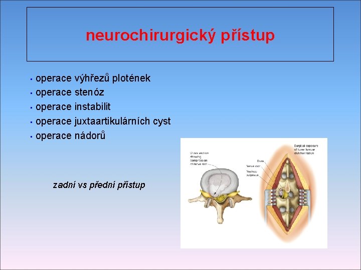 neurochirurgický přístup operace výhřezů plotének • operace stenóz • operace instabilit • operace juxtaartikulárních