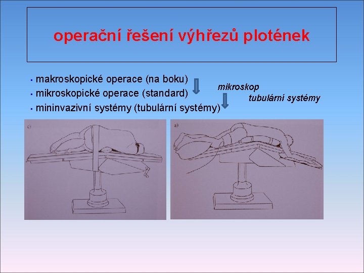 operační řešení výhřezů plotének makroskopické operace (na boku) mikroskop • mikroskopické operace (standard) tubulární