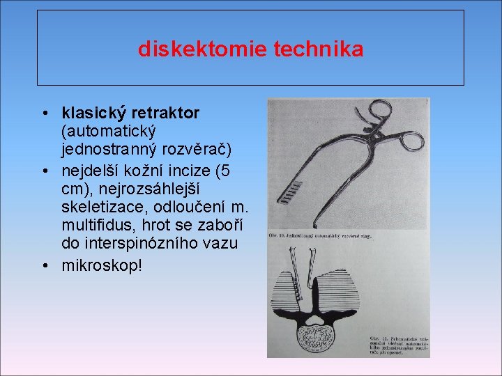 diskektomie technika • klasický retraktor (automatický jednostranný rozvěrač) • nejdelší kožní incize (5 cm),