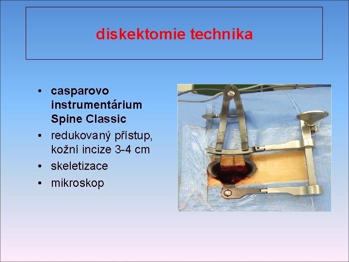 diskektomie technika • casparovo instrumentárium Spine Classic • redukovaný přístup, kožní incize 3 -4