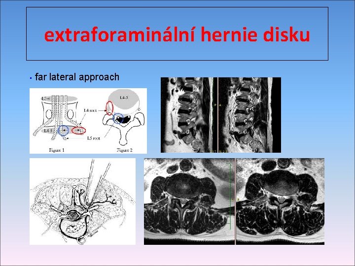 extraforaminální hernie disku far lateral approach • 