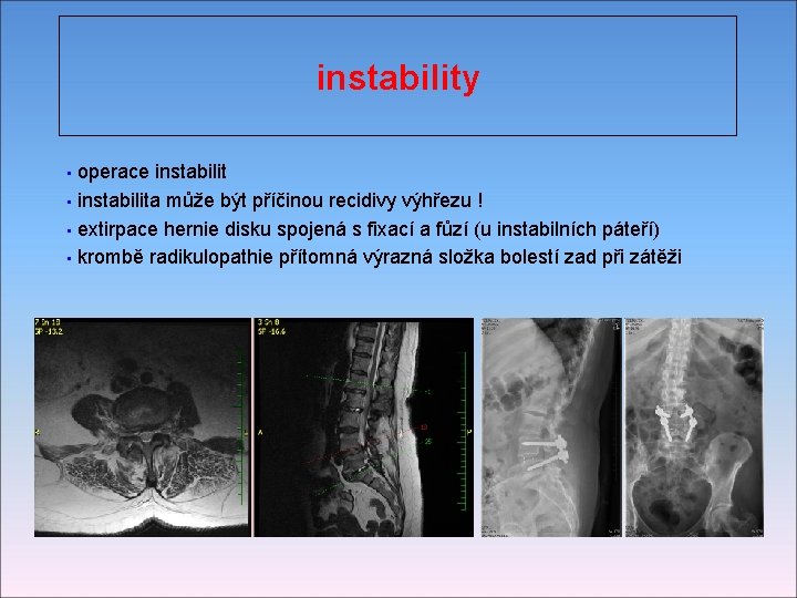 instability • operace instabilit • instabilita může být příčinou recidivy výhřezu ! • extirpace