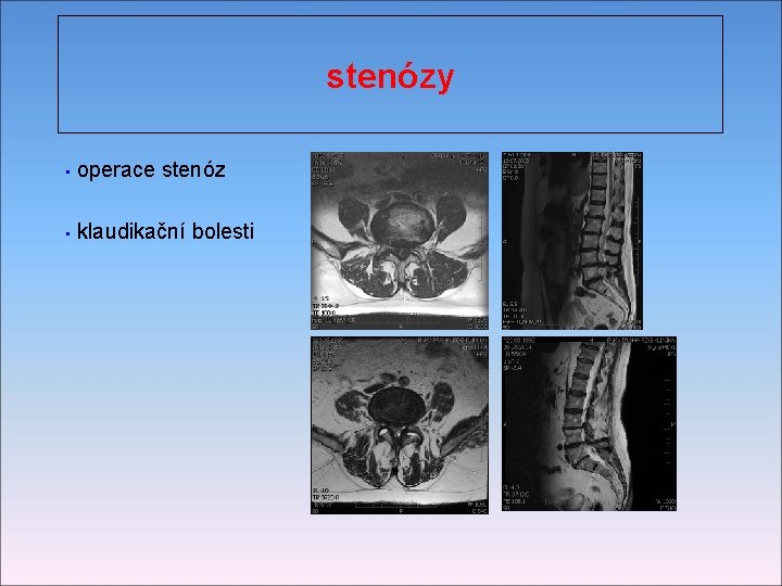 stenózy operace stenóz • klaudikační bolesti • 