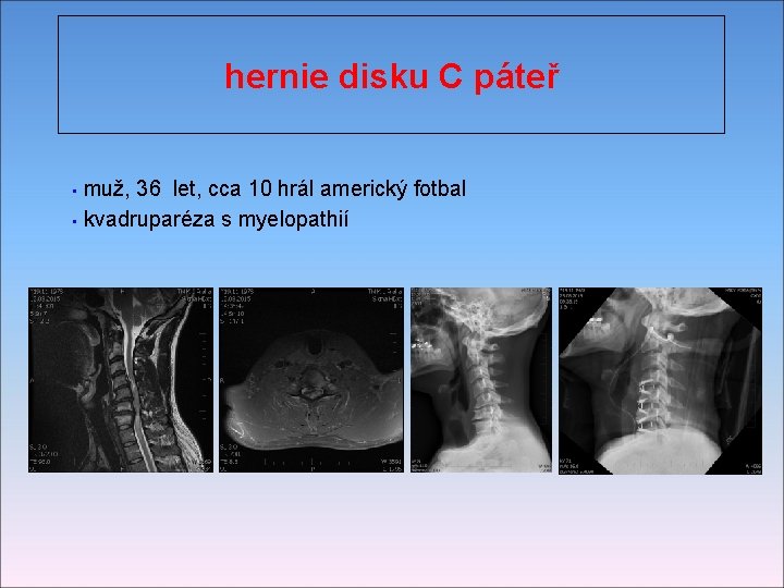 hernie disku C páteř muž, 36 let, cca 10 hrál americký fotbal • kvadruparéza