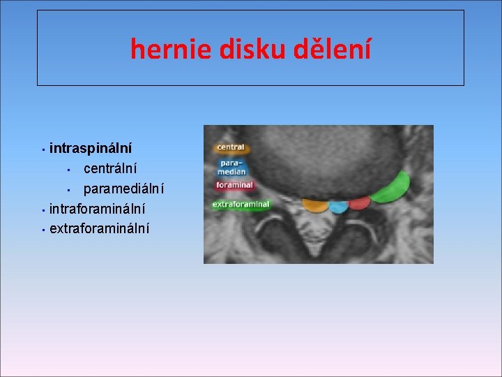 hernie disku dělení intraspinální • centrální • paramediální • intraforaminální • extraforaminální • 