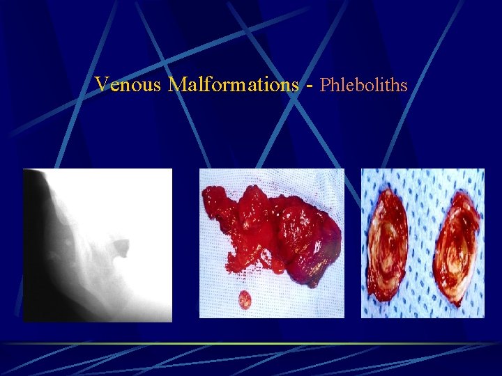 Venous Malformations - Phleboliths 