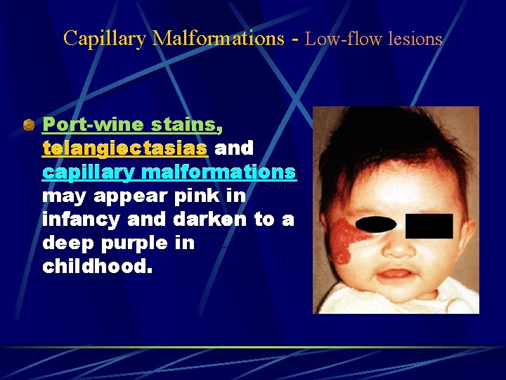 Capillary Malformations - Low-flow lesions Port-wine stains, telangiectasias and capillary malformations may appear pink