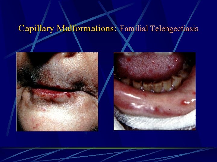Capillary Malformations: Familial Telengectiasis 