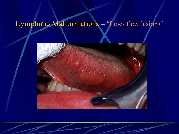 Lymphatic Malformations – “Low- flow lesions” 