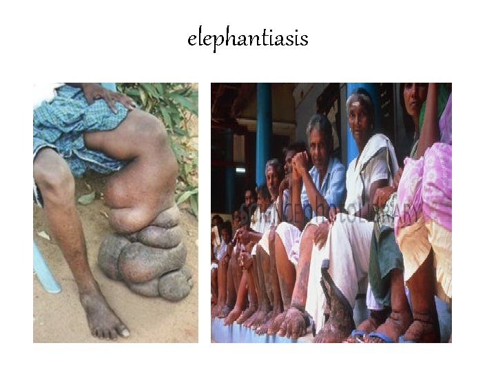 elephantiasis 