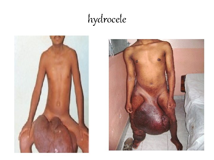 hydrocele 