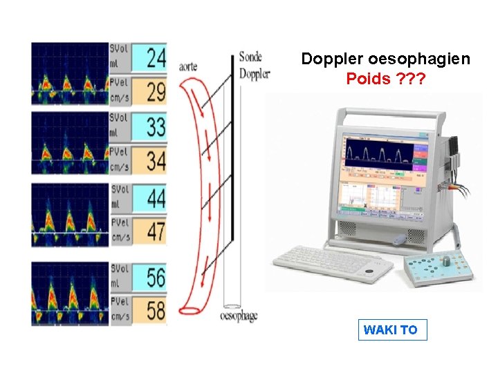 Doppler oesophagien Poids ? ? ? WAKI TO 