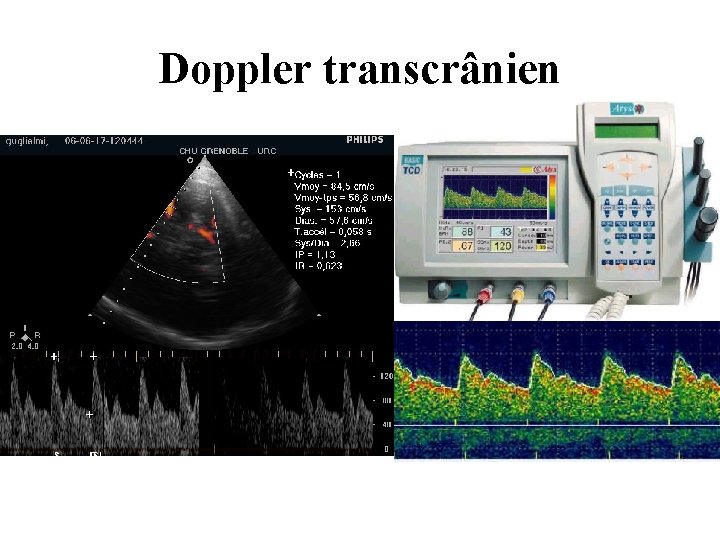 Doppler transcrânien 