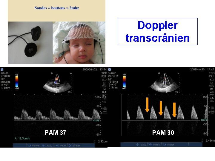 Doppler transcrânien PAM 37 PAM 30 