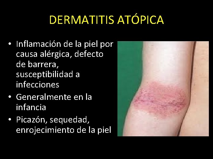 DERMATITIS ATÓPICA • Inflamación de la piel por causa alérgica, defecto de barrera, susceptibilidad